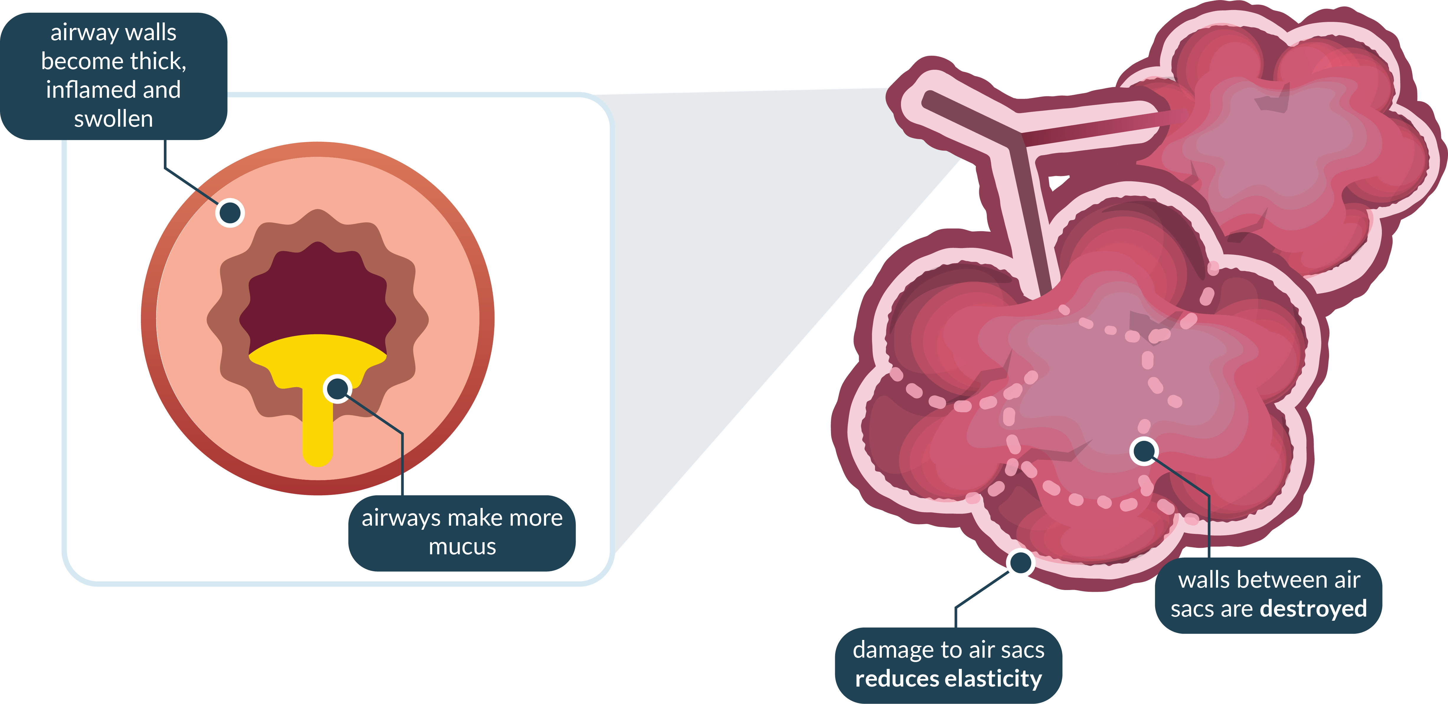 airway_with_copd